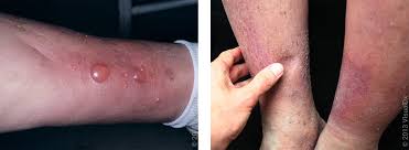 Image result for Stasis Dermatitis