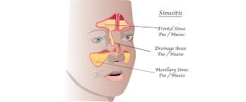 Image result for Sinus Surgery