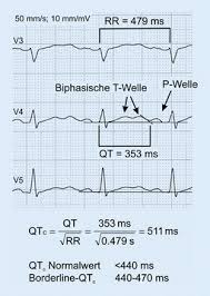 Long Qt Syndrom Als Differenzialdiagnose Einer Grand Mal Epilepsie Springerlink