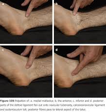 Bone spurs are abnormal spiking outgrowth of the bone around the edge or border of the bone. Clinical Examination Of The Ankle And Foot