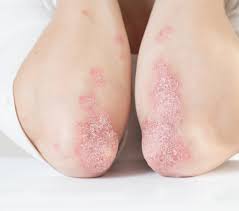 Psoriase, psoríase, área de projecto. Entenda O Que E Psoriase Doenca Inflamatoria Na Pele De Kelly Key