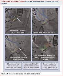 Maybe you would like to learn more about one of these? The Basilica Trial Prospective Multicenter Investigation Of Intentional Leaflet Laceration To Prevent Tavr Coronary Obstruction Sciencedirect