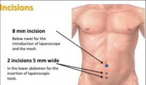 Image result for Inguinal hernia man