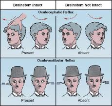 Image result for Oculovestibular Testing