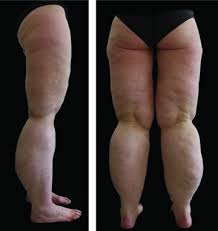 Practice an ankle flexion exercise. Thick Legs Not Always Lipedema Reich Schupke 2013 Jddg Journal Der Deutschen Dermatologischen Gesellschaft Wiley Online Library