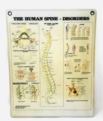 Vintage 1986 The Human Spine Disorders Anatomical Chart Co Medical Poster Sign