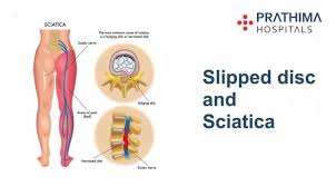 A slipped disc in your lower back (lumbar region) causes symptoms like Slipped Disc And Sciatica Best Hospital In Hyderabad Best Hospital In Kukatpally Kachiguda