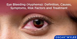 Image result for Hyphema