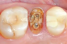 Collacone Botiss Dental Botiss Biomaterials Gmbh