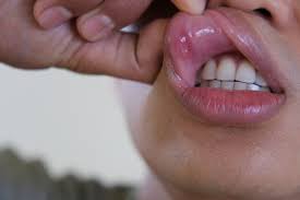 Image result for gum cancer symptoms