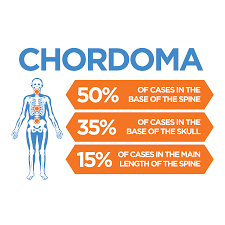 Maybe you would like to learn more about one of these? Chordoma Bone Cancer Research Trust