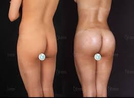 Offered at our convenient location in hamburg. 5 Countries To Get Affordable Brazilian Butt Lift Compare Prices Bookimed