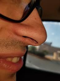 How to get rid of blackheads, according to top dermatologists? My 24 Yr Old Boyfriend Has One White Nose Hair Mildlyinteresting