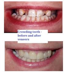 Dr david bloom, a top dentist, explains how long they should last. Veneers Teeth Whitening Dental Crowns Teeth Whitening And Braces