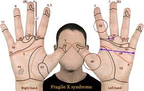 Assignment On Fragile X Syndrome Assignment Point