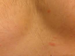 Exista o multime de factori care pot cauza aceste eruptii, de la alergii si urticarie pana la infectii virale si meningita. Cauze Posibile Intepaturile De Insecte Tipuri Tratament Si Prevenire Cabanavartop Ro