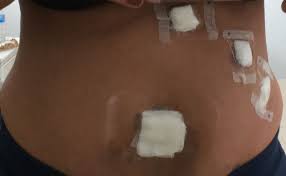 My Swollen Belly After Gallbladder Surgery After Gallbladder Surgery Gallbladder Surgery Gallbladder