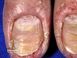 Image result for paronychium