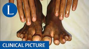 Image result for Clubbing nails feet