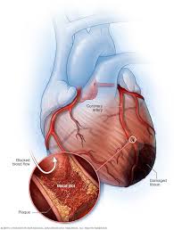 We did not find results for: Heart Attack Symptoms And Causes Mayo Clinic