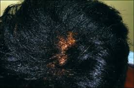Black Hair Thinning At Crown Stop Black Hair Breakage At The Crown In 7 Steps
