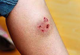 This may be made by adding approximately one level teaspoonful (5 ml) of salt (or epsom salts) to two cups (500 ml) of water. If A Dog Bites You Do These 6 Things Now Health Essentials From Cleveland Clinic