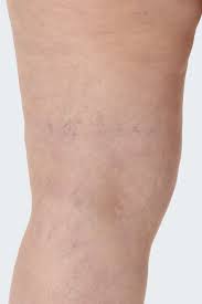 They usually occur in the legs, but also can form in other parts of the body. Preventing Spider Veins Causes And Treatment Medi