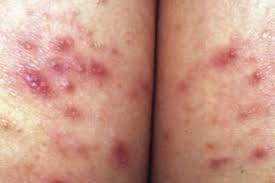 Image result for folliculitis symptoms