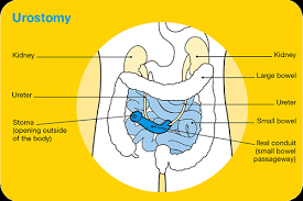 You may be given contrast liquid to help your bladder, kidneys, and ureters show up better in pictures. Living With A Bladder Reconstruction Cancer Council Victoria
