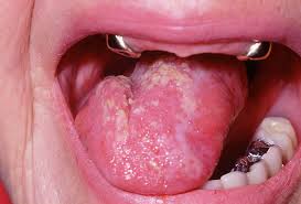 Image result for Leukoedema