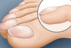 The warts are usually found at the. Burning Or Swollen Feet What Foot Pain Symptoms Say About Your Health