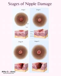 🤱 Understanding Nipple Pain in Breastfeeding​ Experiencing nipple pain and  damage during breastfeeding can pose unexpected challenges. Nipple pain  during breastfeeding is not normal and should be addressed as soon as  possible.