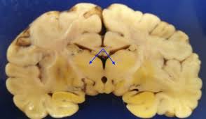 Image result for Kernicterus