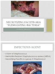 Check spelling or type a new query. Necrotizing Fasciitis