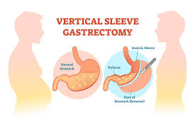 49 year old male who underwent gastric sleeve surgery in 2016 and subsequently lost 190 pounds. Gastric Sleeve Surgery Is Vertical Sleeve Gastrectomy Right For You