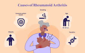 Image result for Rheumatoid Factor