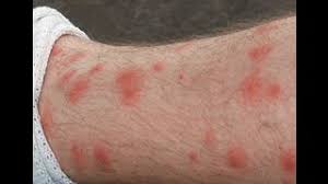 Check spelling or type a new query. How To Get Rid Of Chigger Bites And Stop Itching Naturally Youtube
