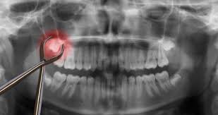 Images after wisdom tooth extraction. Tooth Extraction Healing What To Expect Dental Dorks
