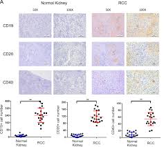 Lymph nodes around the kidney the main vein in the kidney (called the renal vein) the large vein in the abdomen leading to the heart (called the vena cava) Tumor Educated B Cells Promote Renal Cancer Metastasis Via Inducing The Il 1b Hif 2a Notch1 Signals Cell Death Disease