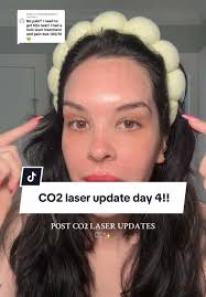 Replying to @4747685846363 CO2 laser updates! 4 days since I’ve gotten the  laser and I’m lovinggggg the results so far!! So far I am seeing SO much  pigment coming off. Excited to get through the next ...
