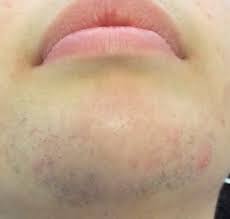 Based on the area of the hair to be removed your dermatologist will decide on when i was having laser hair removal done on various areas the technician could use the higher setting on the laser for my back, abs and. How I Do It Laser Hair Removal An Overview The Pmfa Journal