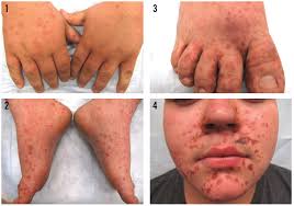 Image result for Hand foot and mouth disease HFMD roof of mouth