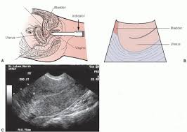 Schau dir angebote von ultra son bei ebay an. Pelvic Ultrasound In The Nongravid Patient Radiology Key