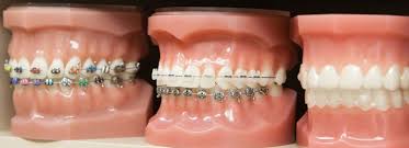 Dental Braces San Antonio| Affordable Orthodontics Texas |Orthodontic  Treatment in San Antonio, TX