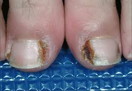 Image result for Paronychia feet