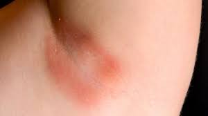 Rashes and itching all over body with welts.increasing all over body daily? Common Skin Rashes Everyday Health