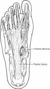 A plantar fibroma can develop in one or both feet, is benign (nonmalignant) and usually will not go away or get smaller without treatment. Plantar Fibroma Acfas