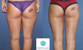 Playmate Und Bachelor Star Saskia Atzerodt Gewinnt Durch Lipodem Op Lebensqualitat Zuruck Medical Inn Gmbh Co Kg Pressemitteilung Lifepr
