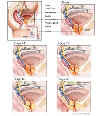 How prostate cancer spreads and progresses. Prostate Cancer Treatment Pdq Patients Siteman Cancer Center