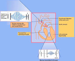 Aortic Stenosis Symptoms And Signs Of Aortic Stenosis